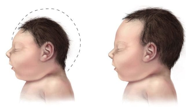 Zika Virus
