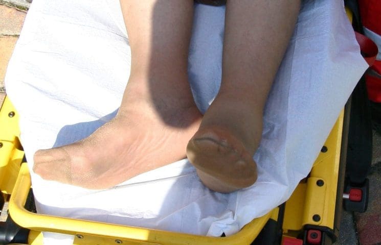 Heupfractuur